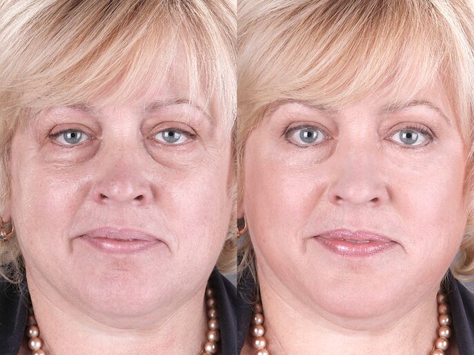 vor und nach der Verwendung des Massagegeräts zur Verjüngung von ltza photo 3