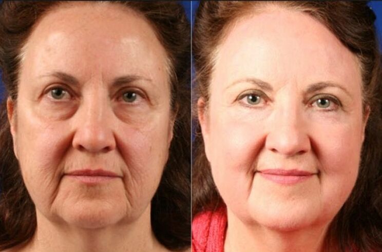 vor und nach der verwendung des ltza rejuvenation massager photo 6