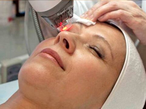 Laserbehandlung der Haut um die Augen
