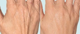 Haut der Hände vor und nach der fraktionierten Therapie. 