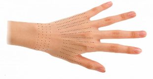 Injektionsstellen für Hände während der Biorevitalisierung. 