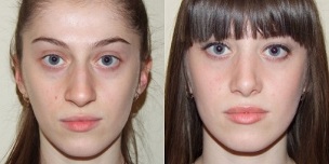 vor und nach der Plasma-Hautverjüngung
